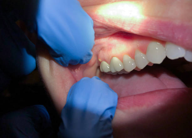 Tooth Infection Emergency Dentist in MI